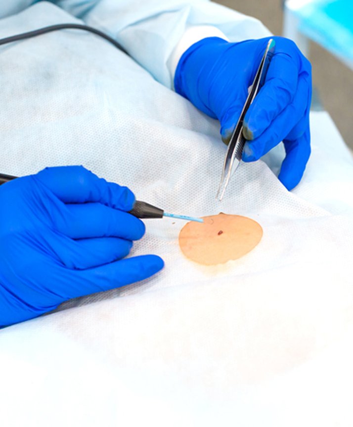 Curetagem e eletrodissecção