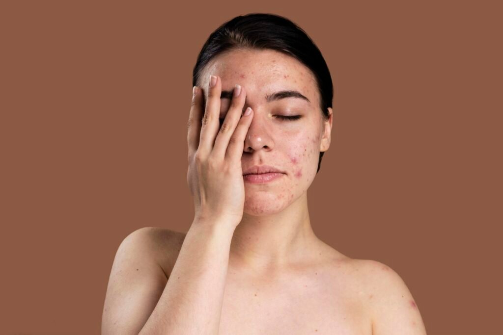 Acne da mulher adulta: o que é e como tratar com segurança