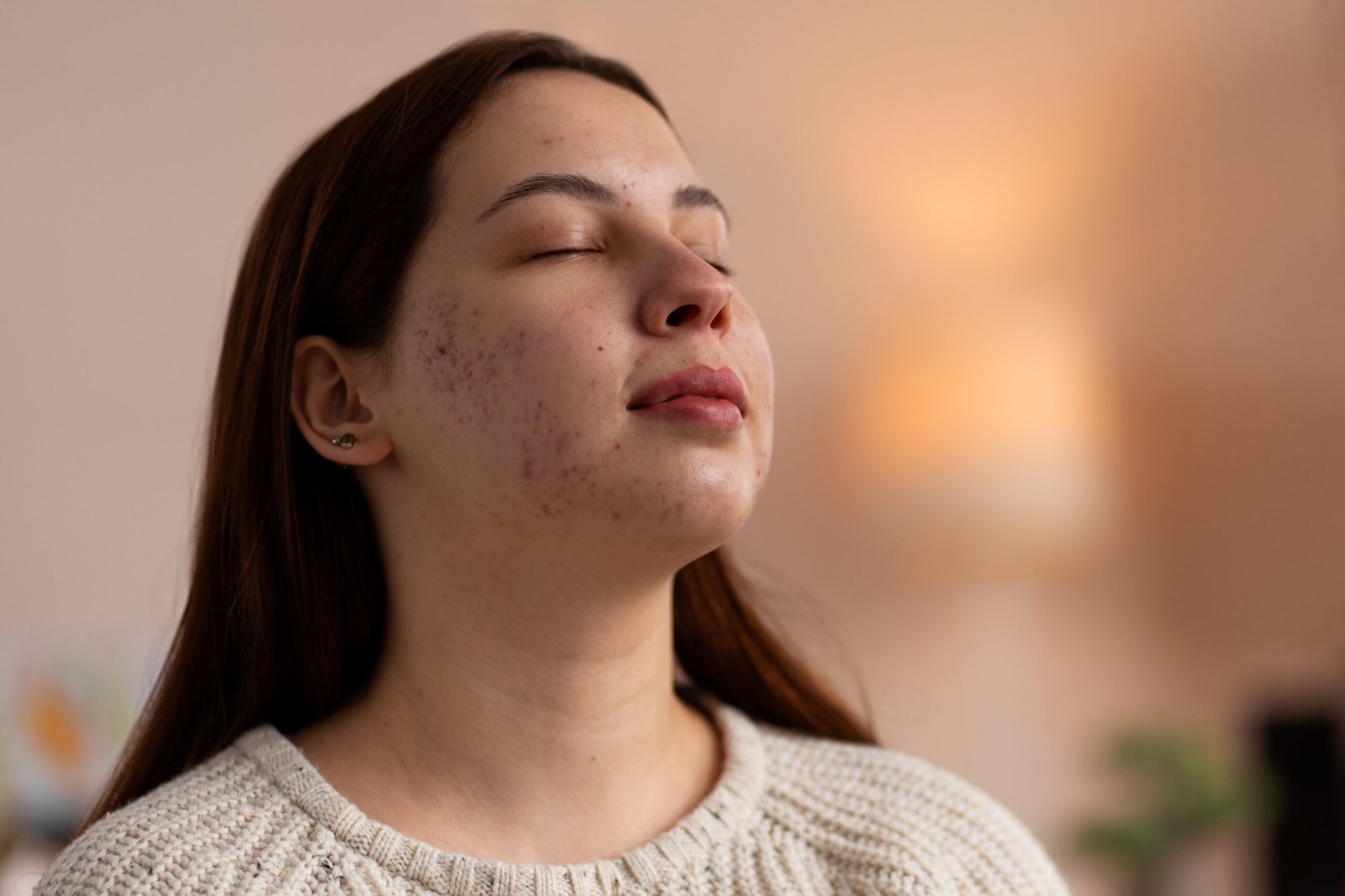Acne e idade: por que ela não some quando você cresce